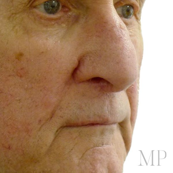 Basal Cell Carcinoma | Matthew Potter