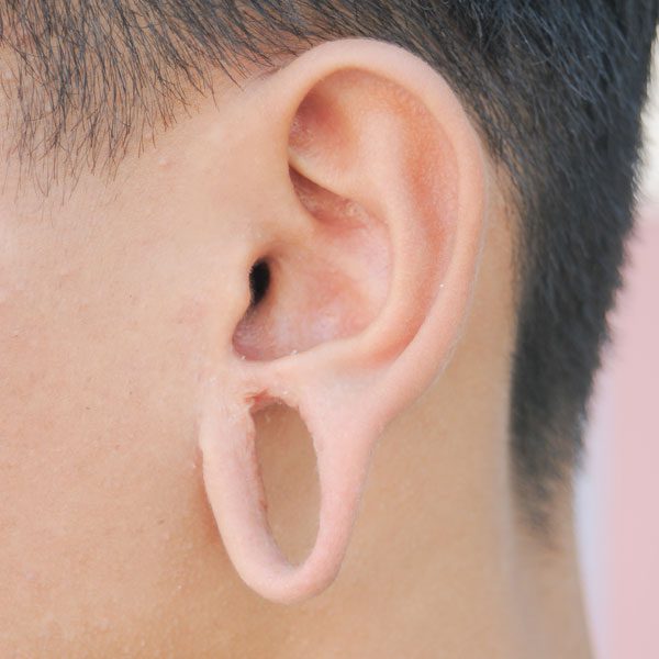 Earlobe Correction Matthew Potter